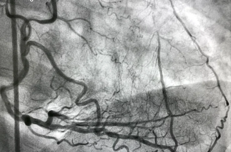 Angiogram