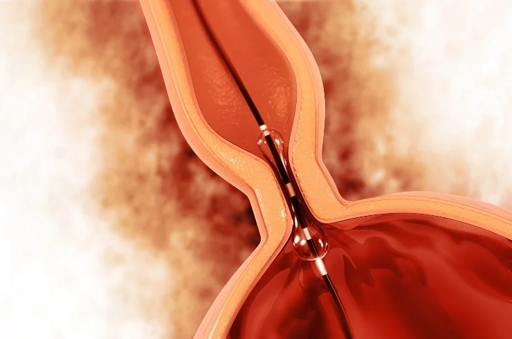 Coronary Angioplasty and Stenting