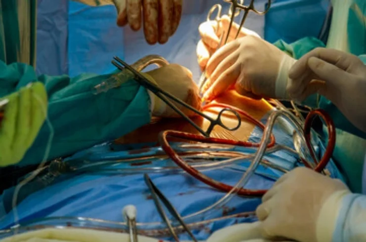 Coronary Artery Bypass Grafting