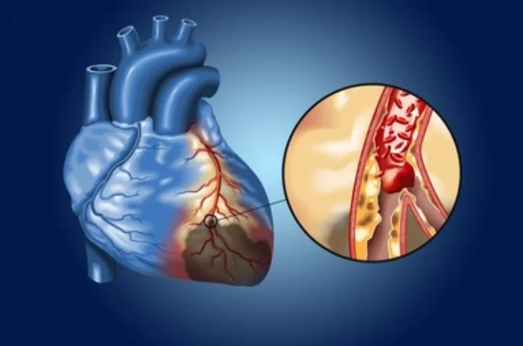 Coronary Artery Disease