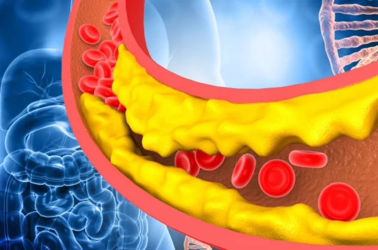 Lipid Disorders