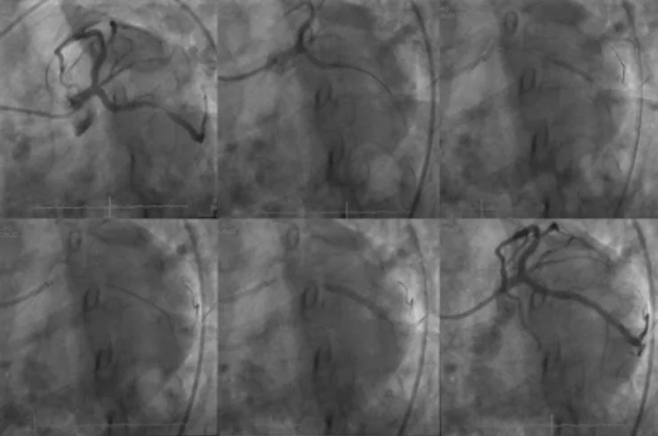 Percutaneous Coronary Intervention